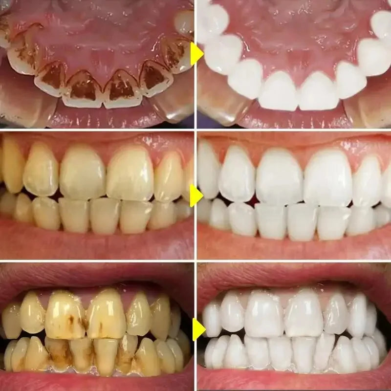 5 Days Teeth Whitening Powder Remove Plaque Stains Dental Care Products